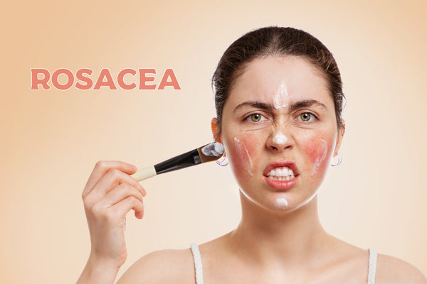 UNDERSTANDING ROSACEA